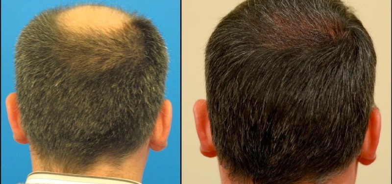 natural_vs_clinical_hair_growth